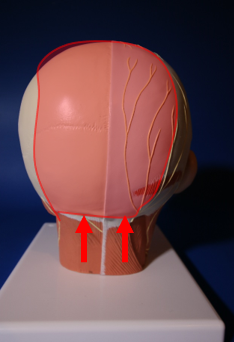 B - Occipital migraines